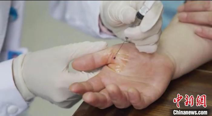 嘉善群眾體驗(yàn)小針刀?！〖紊平y(tǒng)戰(zhàn) 供圖