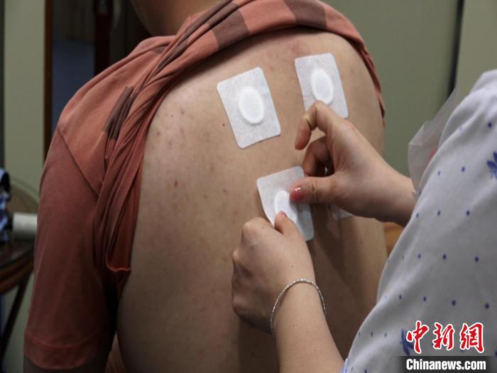 圖為醫(yī)生正在為民眾貼“三伏貼”。　唐蔚晴 攝